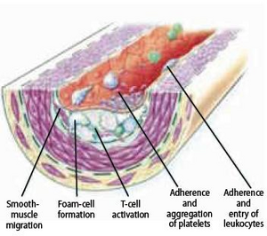 Figure 7 - Fatty streak formation revealing platelet aggregation on the endothelial surface.png