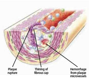 Figure 10 - The ruptured plaque..png