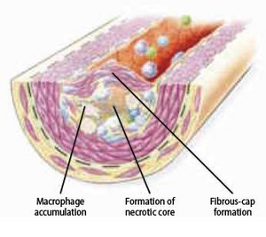 Figure 9 - Fibrous cap formation.png