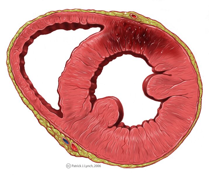 File:Heart ant wall infarction.jpg